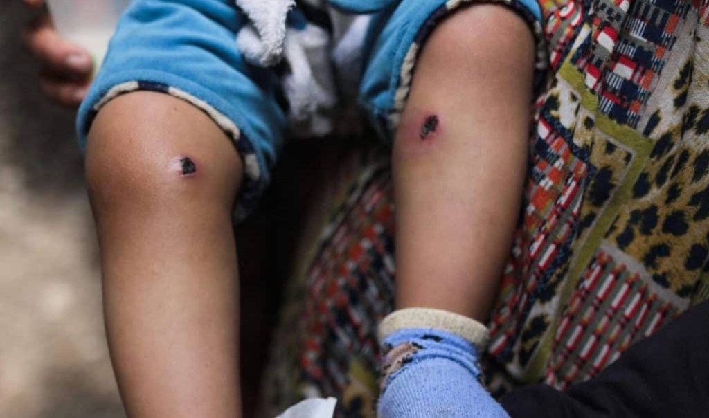 18-Month Old Boy Gets Cigarettes Burns on Legs During IDF Torture Session With Child’s&nbsp;Father